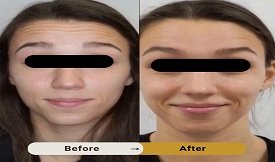botox injections in Islamabad