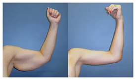 Arm Lift Surgery in Islamabad
