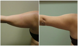 Best Arm Lift Surgery in Islamabad