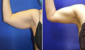 Arm Lift Surgery in Islamabad