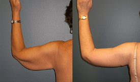 Arm Lift Surgery in Islamabad