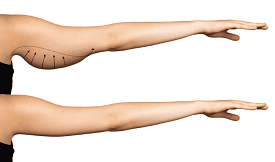 arm lift surgery in islamabad
