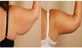 arm lift treatment in islamabad