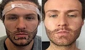 Beard hair transplant before after results