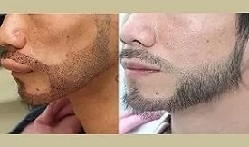 Beard hair transplant before after