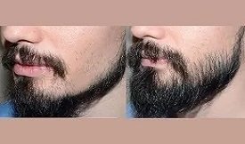 Beard hair transplant cost in Islamabad