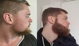Beard hair transplant in Pakistan