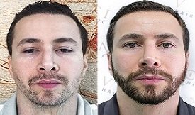 Best Beard hair transplant in Islamabad