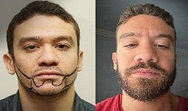 Best Beard hair transplant