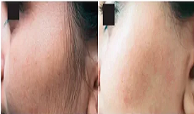 Birthmark removal in Islamabad
