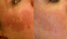best Birthmark removal in Islamabad