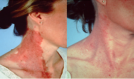 Birthmark removal in Islamabad