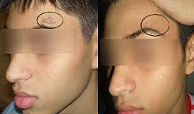 effective Birthmark removal in Islamabad