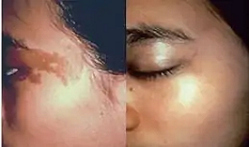 Birthmark removal results in Islamabad