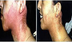 safe Birthmark removal in Islamabad