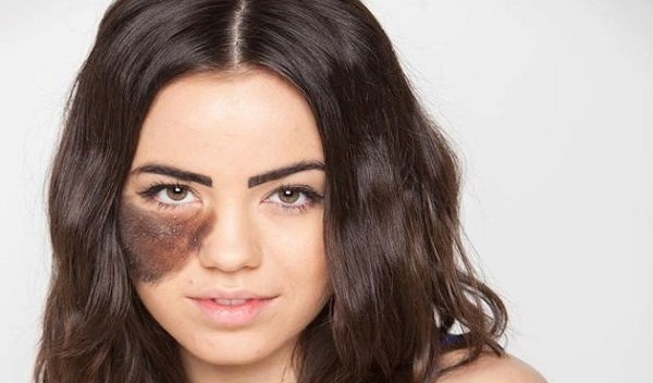 Birthmark removal in Islamabad