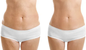 Body Contouring in Islamabad