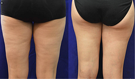 Body Contouring in Islamabad