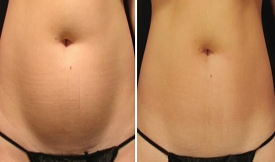 Body Contouring treatment in Islamabad