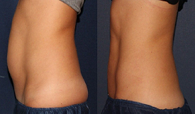 Body Contouring Islamabad