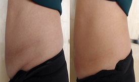 Body Contouring results in Islamabad