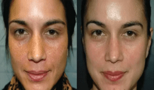 chemical peels