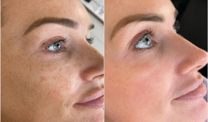 chemical peels in islamabad