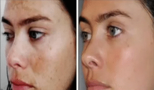 chemical peels islamabad