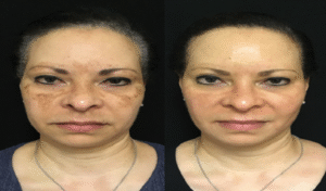 chemical peels in islamabad