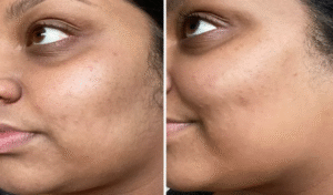 chemical peel in islamabad