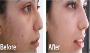 best chemical peel islamabad