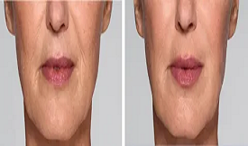 Dermal fillers in Islamabad