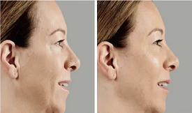 Dermal Filler Islamabad
