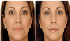 Best Dermal fillers in Islamabad