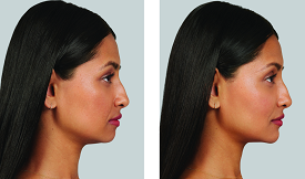 Dermal fillers in Islamabad