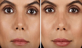 Dermal fillers in Islamabad