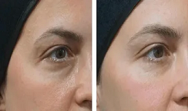 Dermal fillers Benefits in Islamabad