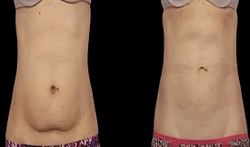 Fat melting injections treatment in Islamabad