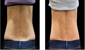 Top Fat melting injections in Islamabad