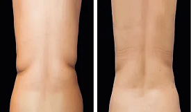 Fat melting injections in Islamabad Results