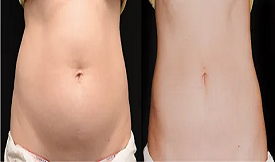 Effective Fat melting injections in Islamabad