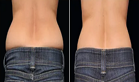 Fat melting injections in Islamabad