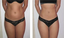 Best Fat melting injections in Islamabad