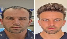 Hair Transplant before after