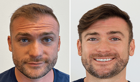 Hair Transplant cost before after