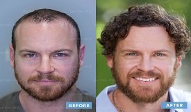 Hair Transplant in Islamabad