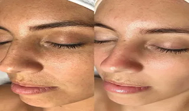 Hydrafacial in Islamabad