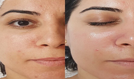 Best Hydrafacial in Islamabad