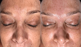 hydrafacial results in islamabad