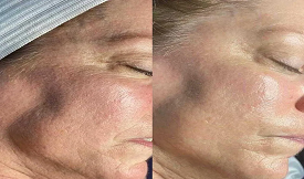 hydrafacial result in islamabad